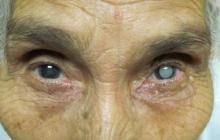 The first signs of an initial cataract