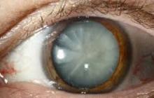 Cataract - description, causes, symptoms (signs), diagnosis, treatment