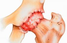 Diagnoza monoartikularnih lezij kolčnega sklepa