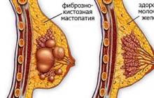 Kaj je difuzna fibrocistična bolezen dojk in kako jo zdraviti Zmerna difuzna fibrocistična bolezen dojk