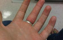 Kako v službi odstraniti prstan s prsta z navojem, brez niti?